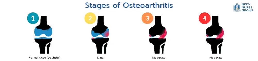 Stages of Osteoarthritis